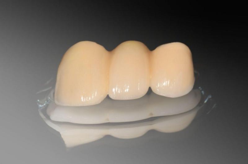 Hình ảnh minh họa câu chuyện của bệnh nhân mất răng số 6 và phục hình bằng Implant